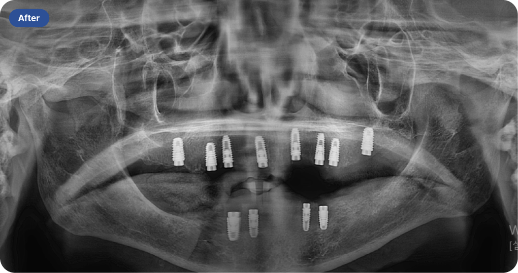 상악 전체 및 하악 오버덴쳐를 활용한 임플란트